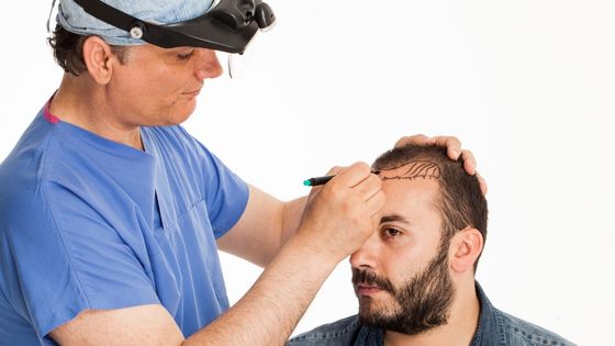 Price Of Hair Transplant in Islamabad